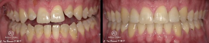 E.C. was unhappy with the shape and size of his lateral incisors while reaching the end of his Invisalign treatment. In a single visit, Dr. Brawner was able to complete veneers and left E.C. with a smile he was confident with.