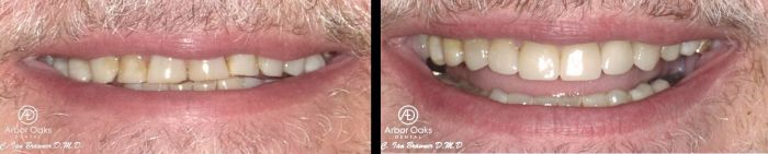 R.M. had severe wear that was functionally becoming an issue.  He also was looking to improve his smile.  After a full mouth rehabilitation involving crowns, onlays and composite restorations, he is now functionally and esthetically outstanding!