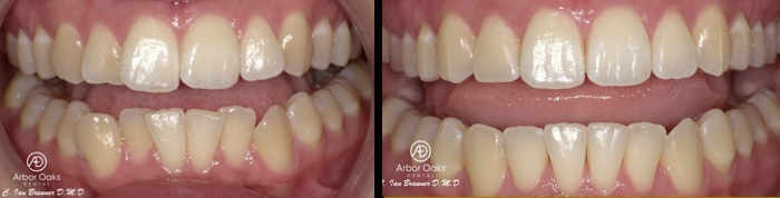 Unhappy with the crowding of her upper and lower front teeth, Danielle’s sixth-month Invisalign treatment granted her the smile she’s always wanted.