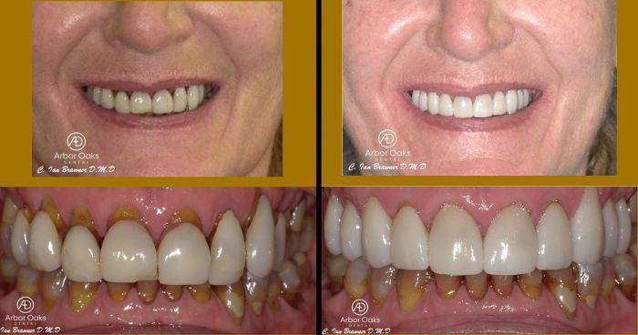 D.E. was unhappy with the breakdown and esthetics of her existing veneers.  New veneers were made to idealize her smile and esthetics.  She could not be happier!
