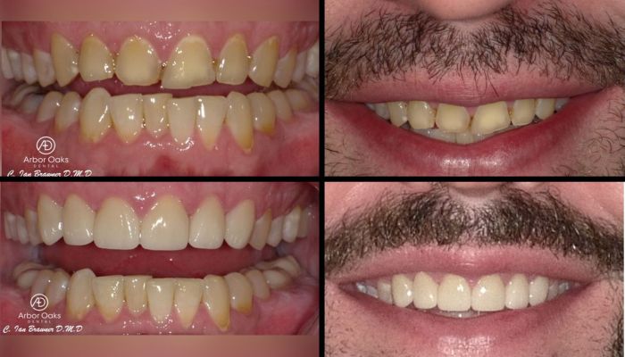Dealing with years of erosion, wear, and fracture D.G. was struggling with the appearance of his upper front teeth. Six veneers later, D.G. is loving his new smile!