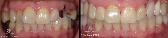 J.S. was struggling with broken and infected teeth, missing teeth, and malalignment.  Invisalign, bridge, and partial denture treatment were completed to restore her form and function, along with a smile she can show off.