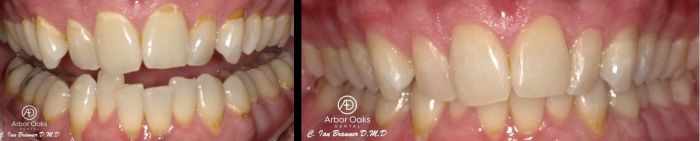 Decay filled Ryan’s gum line, causing harm to his teeth and distracting from the esthetics of his smile. Composite restorations were used to restore the teeth and bring back his beautiful smile.