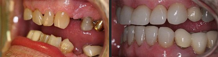 Full mouth reconstruction with crowns