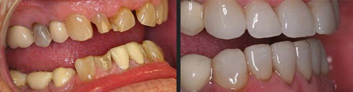 Full mouth reconstruction with crowns