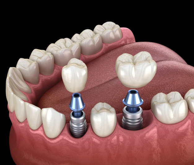 artificial dental implants module