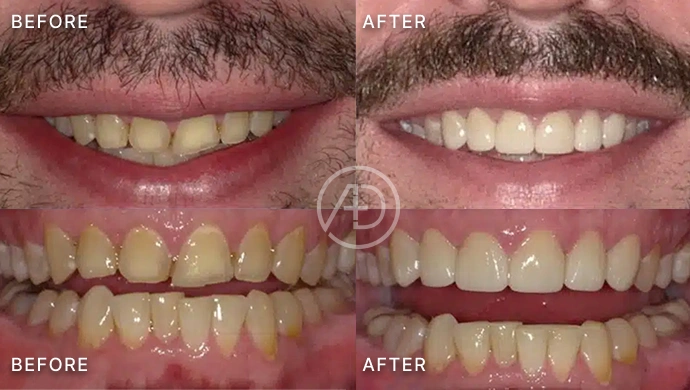 Before and after dental treatment showing improved tooth whiteness and alignment at Arbor Oaks Dental.